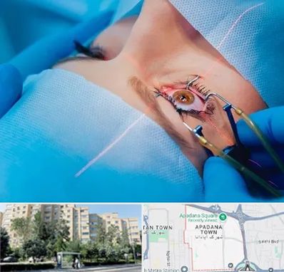 عمل prk چشم در آپادانا