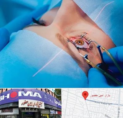 عمل prk چشم در امین حضور