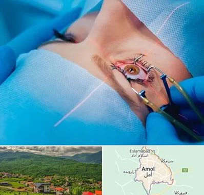 عمل prk چشم در آمل