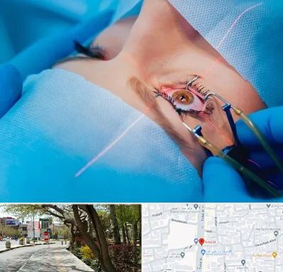 عمل prk چشم در خیابان توحید اصفهان