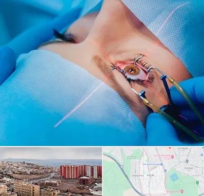 عمل prk چشم در سهند تبریز