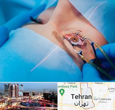 عمل prk چشم در صادقیه 