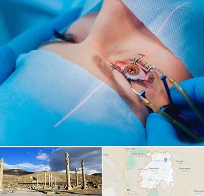 عمل prk چشم در مرودشت