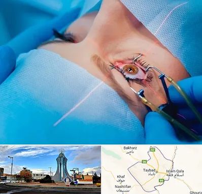 عمل prk چشم در تایباد