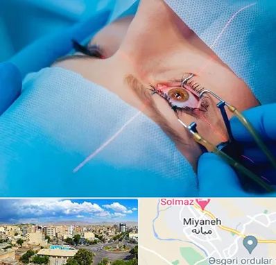 عمل prk چشم در میانه