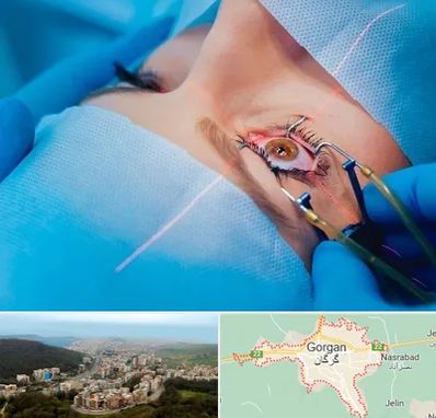 عمل prk چشم در گرگان