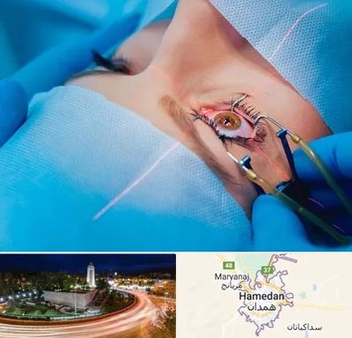 عمل prk چشم در همدان