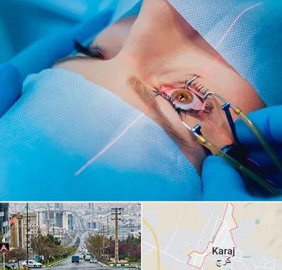 عمل prk چشم در گوهردشت کرج 