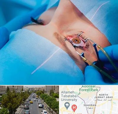 عمل prk چشم در شهران 