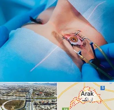 عمل prk چشم در اراک
