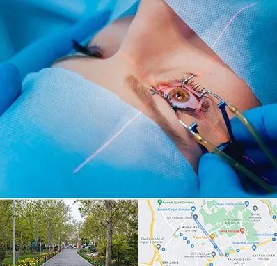 عمل prk چشم در قدوسی غربی شیراز