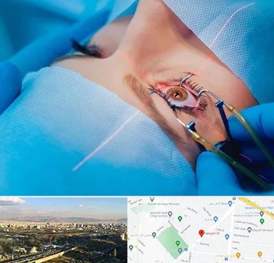 عمل prk چشم در هنگام 