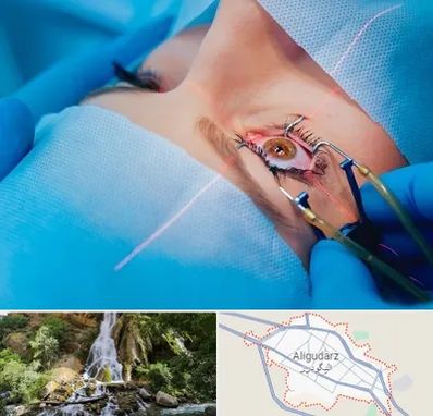 عمل prk چشم در الیگودرز