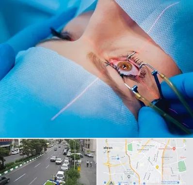 عمل prk چشم در ستارخان 