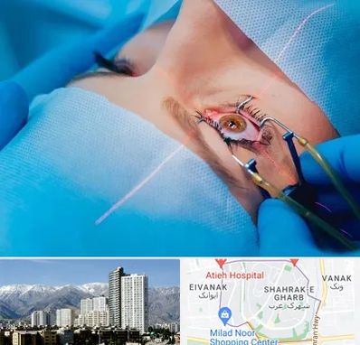 عمل prk چشم در شهرک غرب 