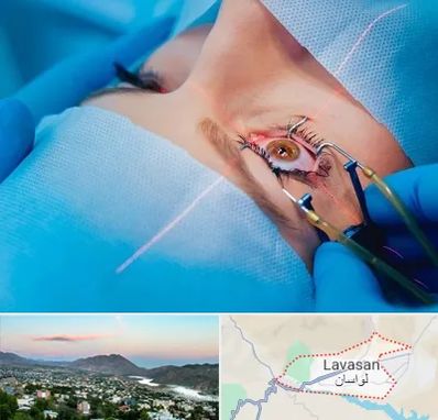 عمل prk چشم در لواسان
