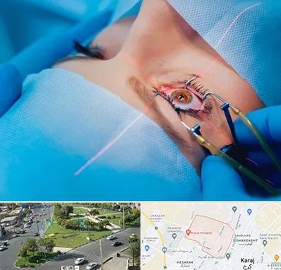 عمل prk چشم در شاهین ویلا کرج