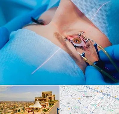 عمل prk چشم در هاشمیه مشهد