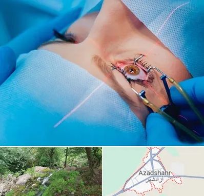 عمل prk چشم در آزادشهر