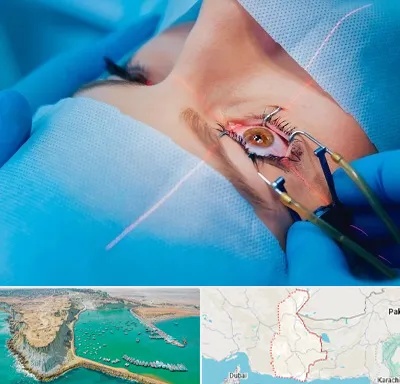 عمل prk چشم در سیستان و بلوچستان