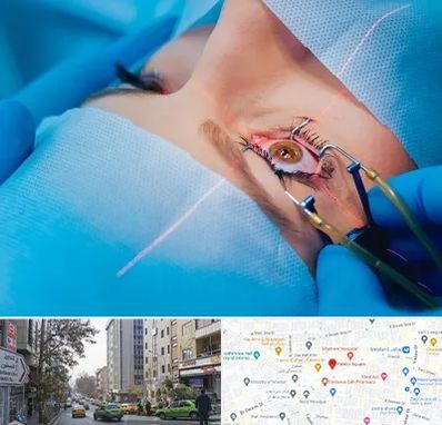 عمل prk چشم در فاطمی 