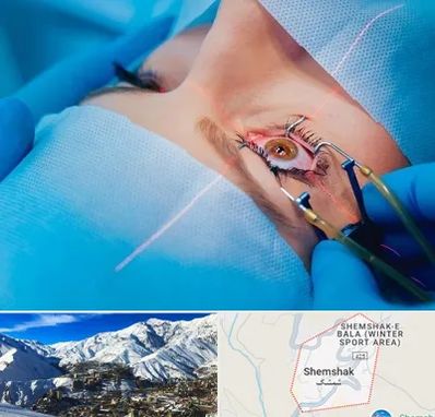 عمل prk چشم در شمشک