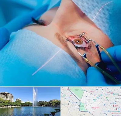 عمل prk چشم در کوهسنگی مشهد