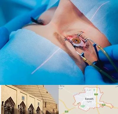 عمل prk چشم در ساوه