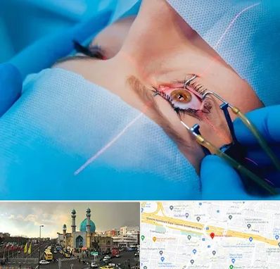 عمل prk چشم در رسالت 