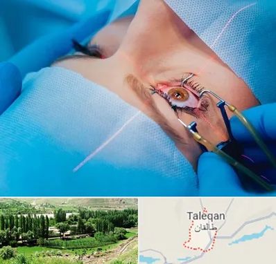 عمل prk چشم در طالقان
