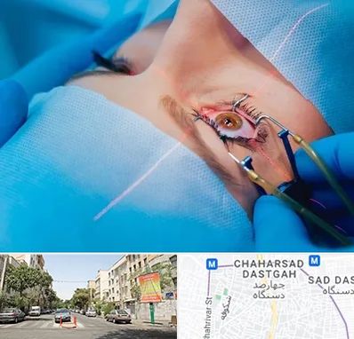 عمل prk چشم در چهارصد دستگاه 