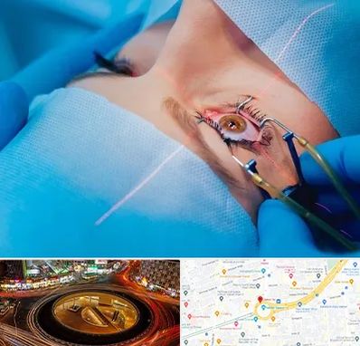 عمل prk چشم در میدان ولیعصر 