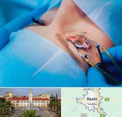 عمل prk چشم در رشت