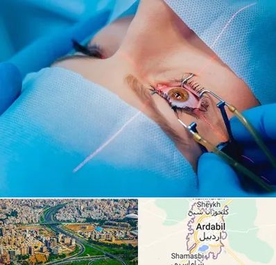 عمل prk چشم در اردبیل