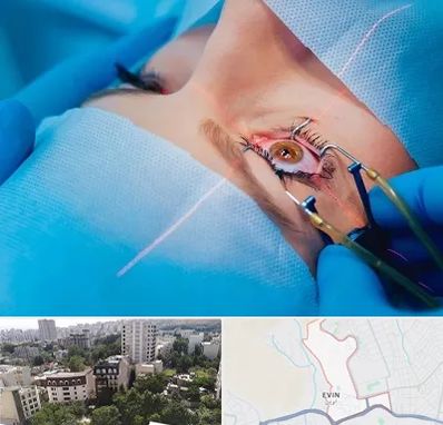 عمل prk چشم در اوین