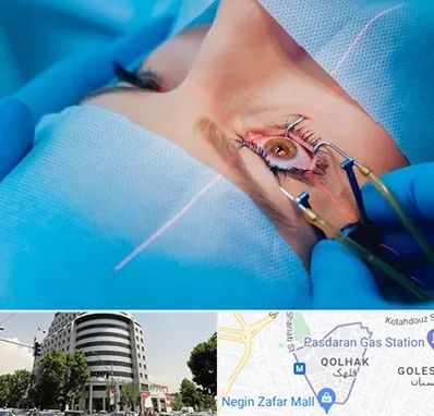 عمل prk چشم در قلهک 