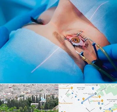 عمل prk چشم در محلاتی شیراز