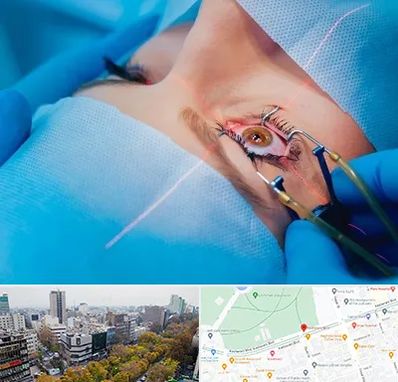 عمل prk چشم در بلوار کشاورز 