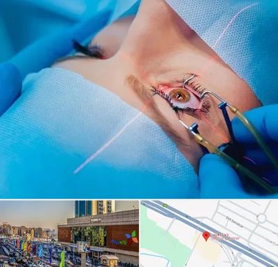 عمل prk چشم در لاله پارک تبریز