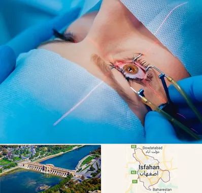 عمل prk چشم در اصفهان