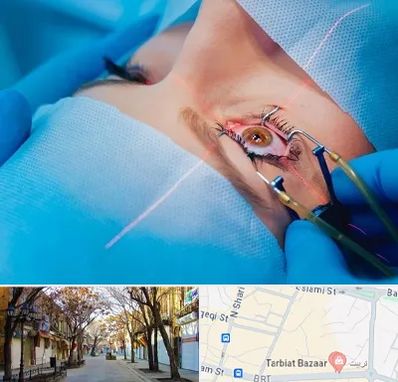 عمل prk چشم در تربیت تبریز