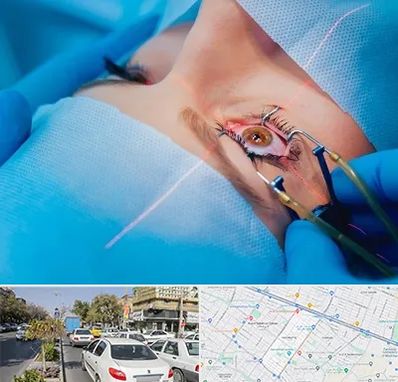 عمل prk چشم در مفتح مشهد