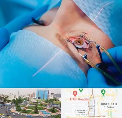 عمل prk چشم در ونک 