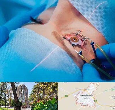 عمل prk چشم در نیشابور