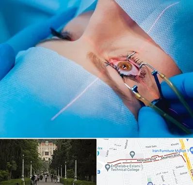 عمل prk چشم در بلوار معلم رشت 