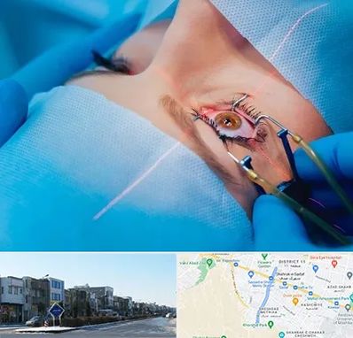عمل prk چشم در شریعتی مشهد