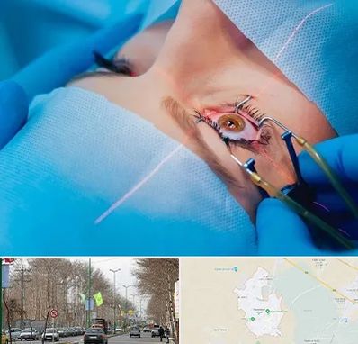 عمل prk چشم در نظرآباد کرج 