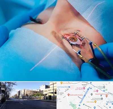 عمل prk چشم در خیابان ملاصدرا شیراز