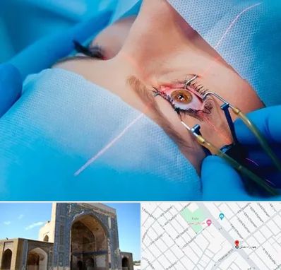 عمل prk چشم در مصلی مشهد