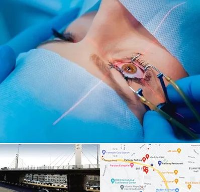 عمل prk چشم در پارک وی 